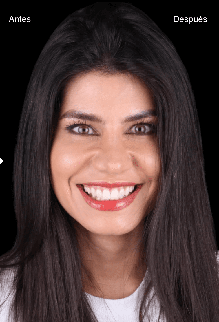 Después del tratamiento de estética dental - Caso 1