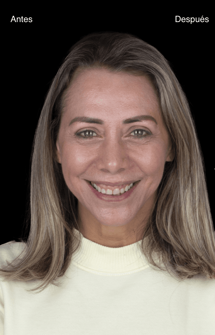 Después del tratamiento de estética dental - Caso 2
