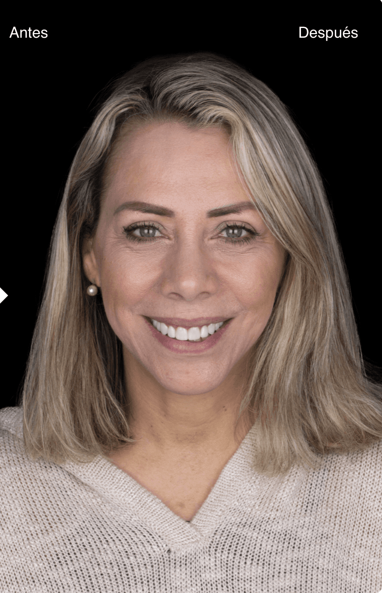 Antes del tratamiento de estética dental - Caso 2